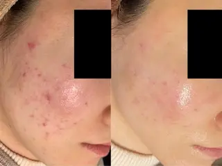肌質改善ハーブ ピーリングBellaのエステ・リラクイメージ