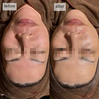 HINANO矢場町店【ヒナノ】所属・脱毛/肌改善🌿 HINANO 村田のエステ・リラクイメージ