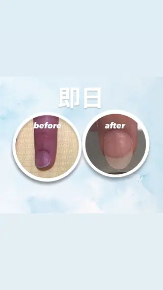 メンズ ネイル 爪ケア/深爪 自爪育成 🐰えむのネイルデザイン