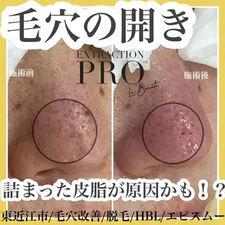 epismoo 脱毛/HBL/毛穴の眉毛・アイブロウイメージ