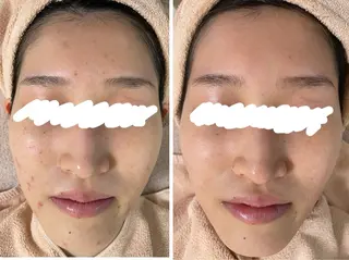 ニキビ&跡改善サロン オーナー光木のエステ・リラクイメージ