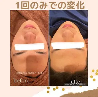 学生ニキビ改善🍀 優しい肌質改善のエステ・リラクイメージ