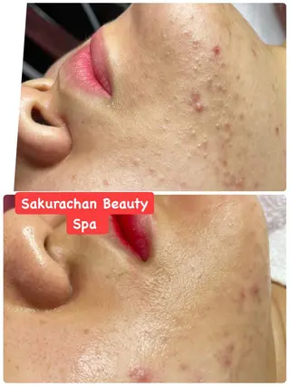 ニキビ、痩身、脱毛、 サクラチャンスパのエステ・リラクイメージ