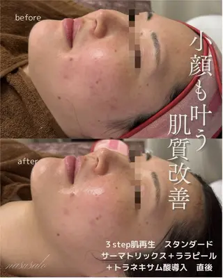 肌質改善フェイシャル 看護師 只野のエステ・リラクイメージ