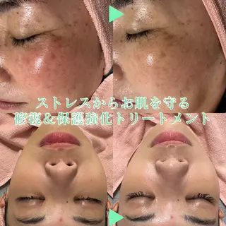 BestBelleꕤ 大阪福島/肌質改善のエステ・リラクイメージ