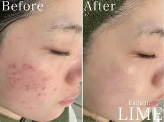 LIME横浜所属・ハーブピーリング🌿 韓国肌管理 Rionのエステ・リラクイメージ