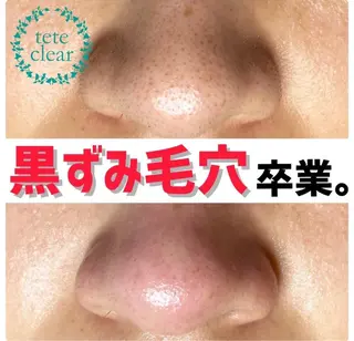 Reine BeautySalon所属・毛穴/シミ肝斑/脱毛 横山梨里のエステ・リラクイメージ