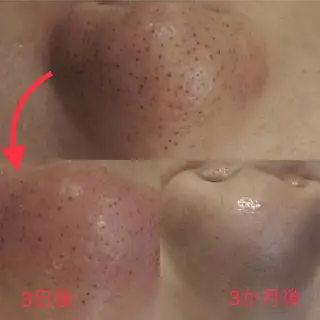 脱毛｜肌質改善｜ ROOM.Sのエステ・リラクイメージ