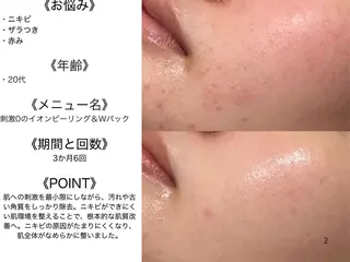6万人の美肌実績🔥 最短ニキビ改善のエステ・リラクイメージ