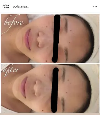 毛穴/ピーリング ララピール/POLAのエステ・リラクイメージ
