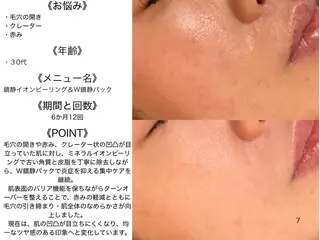 ニキビ特化型エステ 🍋最短で肌質改善のエステ・リラクイメージ