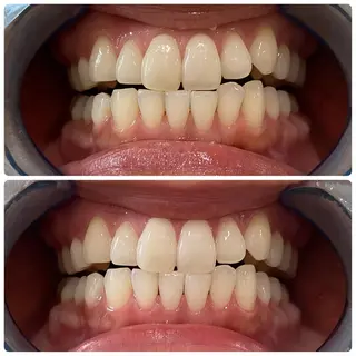 White Berry SELF BEAUTY SALON所属・セルフホワイトニング 🦷口元垢抜け✨のその他イメージ