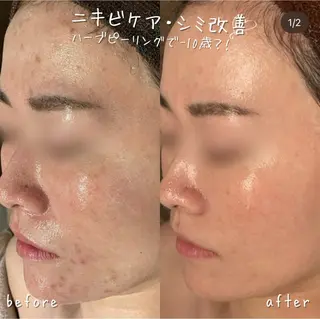 【ハーブピーリング/毛穴洗浄】NA skin 川崎店〜ニキビ・毛穴専門店〜所属・NAskin川崎 皆川のエステ・リラクイメージ