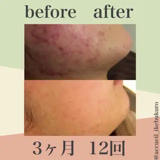 皮膚科より効果あり ⁉️最短ニキビ改善のエステ・リラクイメージ