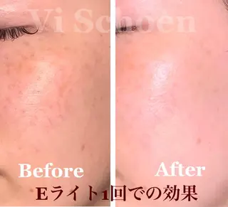 うなじ/もみあげ脱毛 ヴィシェーン佐藤のその他イメージ