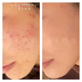 セミロング パーマ ヘアアレンジ メンズ キッズ ネイル マツエク・マツパ アイブロウ ニキビ跡専門サロン Ainaのエステ・リラクイメージ