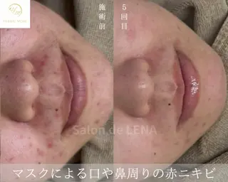 ハーブピーリング・毛穴ケア専門サロンSalon de LENA 栄店所属・ハーブピーリング専門 サロンドレナ　白藤のエステ・リラクイメージ