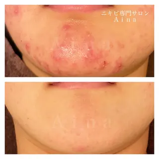 ショート パーマ ヘアアレンジ メンズ キッズ ネイル マツエク・マツパ アイブロウ ニキビ跡専門サロン Ainaのエステ・リラクイメージ