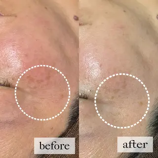 HINANO矢場町店【ヒナノ】所属・脱毛/肌改善🌿 HINANO 村田のエステ・リラクイメージ