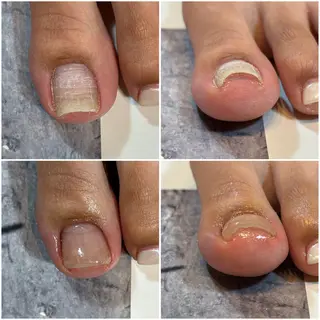 ネイル 巻き爪補正 Umber　Miyaのネイルデザイン