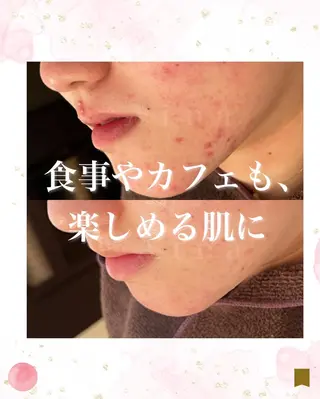 ニキビ跡専門サロン Ainaのエステ・リラクイメージ