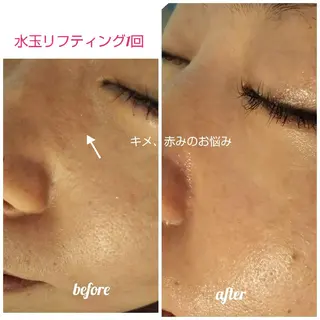 【ニキビ/肌管理】 salon varyのエステ・リラクイメージ