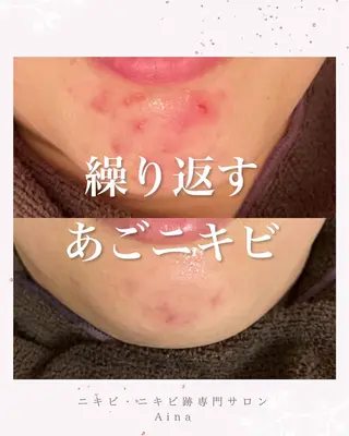 セミロング パーマ ヘアアレンジ メンズ キッズ ネイル マツエク・マツパ アイブロウ ニキビ跡専門サロン Ainaのエステ・リラクイメージ