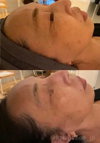 肌質改善 KALANCHOEのエステ・リラクイメージ