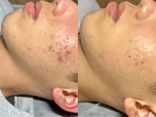 ニキビケア・毛穴洗浄専門店　Drop所属・ニキビケア＆毛穴洗浄 Rikoのエステ・リラクイメージ