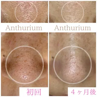 毛穴ケア専門サロンアンスリウム所属・茨城土浦 つくば毛穴 ケア専門サロンのエステ・リラクイメージ