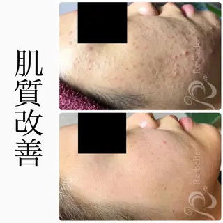 BeSkin藤沢店所属・ニキビ/肌質改善 BeSkin 藤沢店のエステ・リラクイメージ