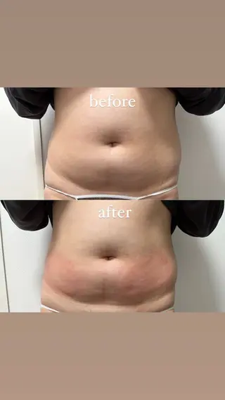 Miiju.所属・Miiju. 石巻市 脂肪冷却  鈴木のエステ・リラクイメージ