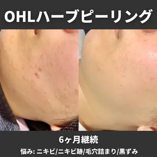 姫路ハーブピーリング・韓国肌管理専門店Emotional所属・Yuka .のエステ・リラクイメージ