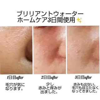 【ニキビ/肌管理】 salon varyのエステ・リラクイメージ