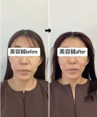 hari salon de off　美容鍼灸×小顔整体【ハリサロンドオフ】所属・美容鍼×小顔整体🤍 ishibashiのエステ・リラクイメージ