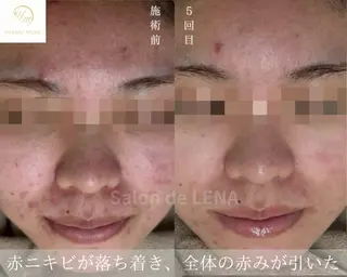 ハーブピーリング・毛穴ケア専門サロンSalon de LENA 栄店所属・ハーブピーリング専門 サロンドレナ 白藤のエステ・リラクイメージ