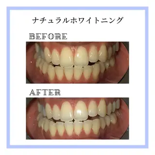 ホワイトニング｜韓国式3D毛穴洗浄 lonhana ﾛﾝﾊﾅ所属・韓国式3D毛穴洗浄 lonhanaのその他イメージ