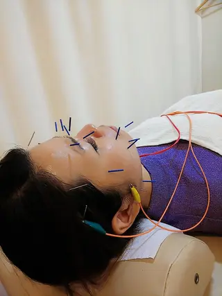 リフトアップ・たるみ ☆美容鍼小顔矯正のその他イメージ