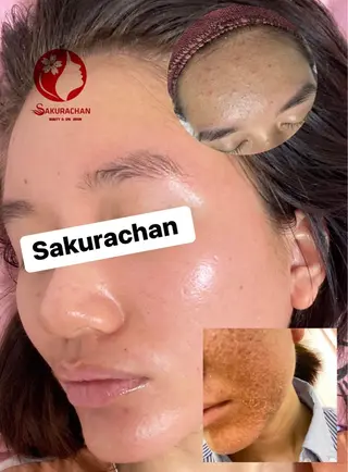 ニキビ、痩身、脱毛、 サクラチャンスパのエステ・リラクイメージ