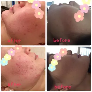 美肌脱毛・ハーブピーリング専門店Larin la beaute所属・Larin la beauteのエステ・リラクイメージ