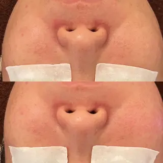 毛穴ケア/毛穴診断/ 毛穴洗浄〔心斎橋〕のエステ・リラクイメージ