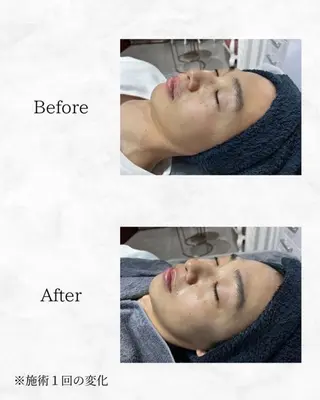 ハーブピーリング🌿 REVI/Ayanoのエステ・リラクイメージ