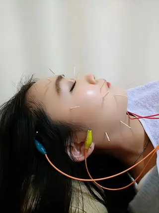 リフトアップ・たるみ ☆美容鍼小顔矯正のその他イメージ