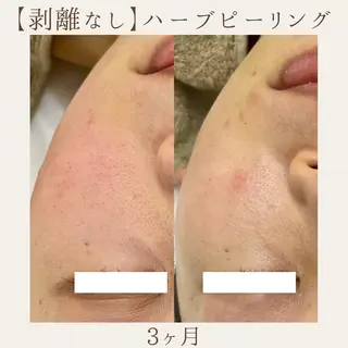 肌質改善サロン renew所属・肌質改善サロン renew/ｳｴｷのエステ・リラクイメージ