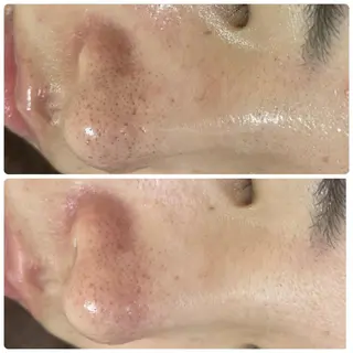 マツエク・マツパ ニキビ毛穴改善 🌿ハーブピーリングのエステ・リラクイメージ