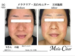 光美容シャムロック バスト、シミ専門店のエステ・リラクイメージ