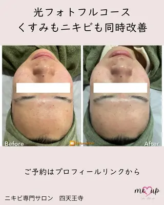 Meupニキビ専門店 背中/ハーブ/ララのその他イメージ