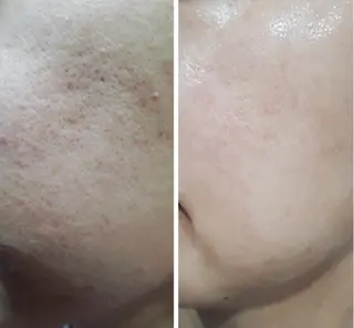 脱毛｜肌質改善｜ ROOM.Sのエステ・リラクイメージ