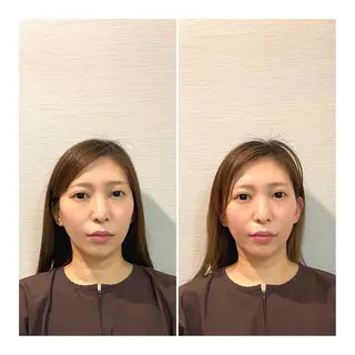 即小顔♥️美容鍼× ハーブピーリングのその他イメージ