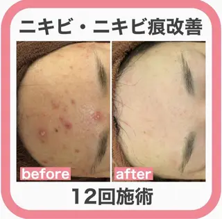 学生ニキビ改善🍀 優しい肌質改善のエステ・リラクイメージ